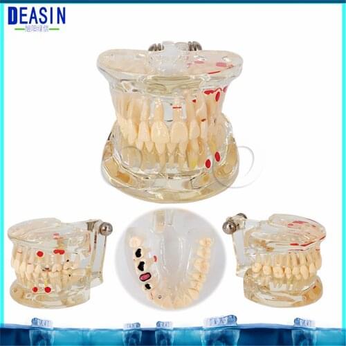Dental Implant Teeth Dental Pathological Teeth Implant Model Teaching Teeth Model & Restoration Bridge Tooth