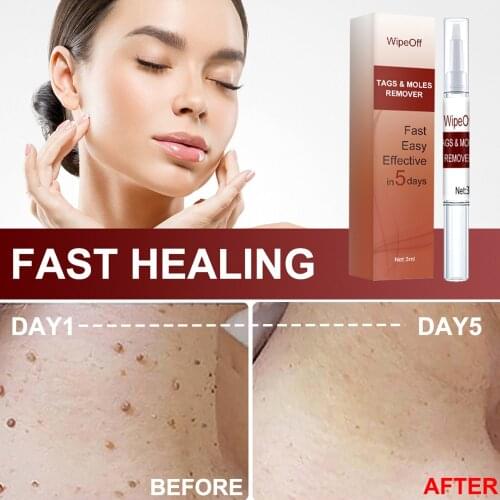 3ml Genital Wart Treatment Papillomas Removal Of Warts Liquid From Skin Tags Removing Against Moles Remover Anti Verruca Remedy