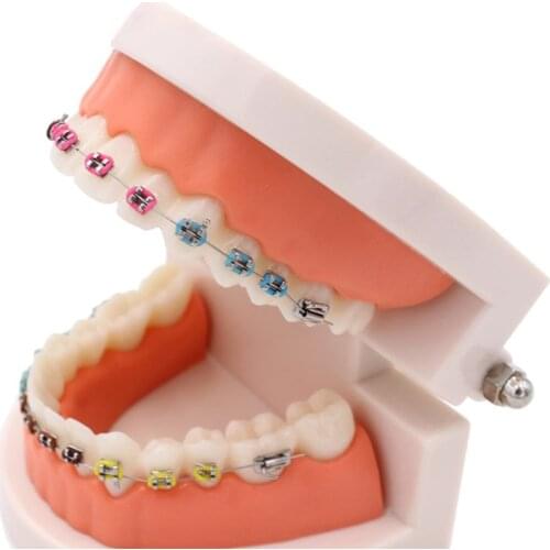 Dental Orthodontic Treatment Model With Ortho Metal Bracket Arch Wire Buccal Tube Ligature Ties