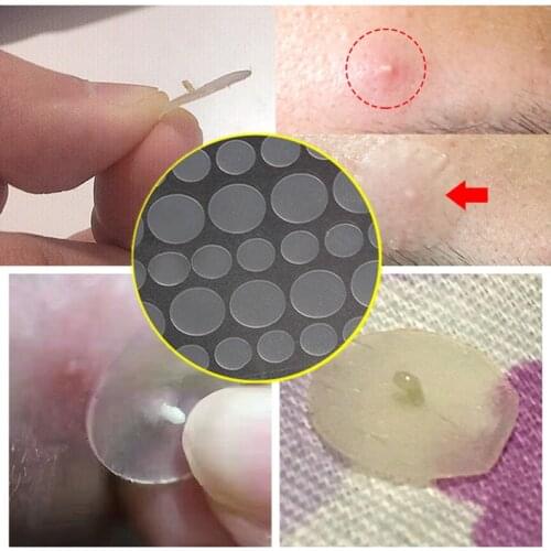 36/72/108pcs Acne Remover Sticker Anti-Acne Blackhead Treatment Plaster Acne Pimple Patch Mask Facial Care Tool Skin Care EC69