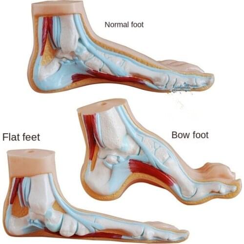 Normal foot, flat foot and arched foot model