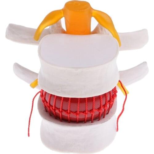 2x Magnification Human Spine Lumbar Vertebral Intervertebral Disc Protrusion Model Anatomical Model for School Teaching Tool