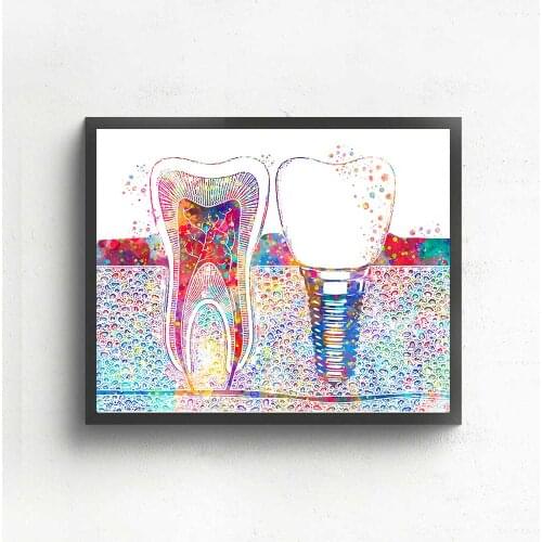 Dental Art Canvas Painting Picture Tooth Implant Print Dentist Wall Art Medicine Hygienist Poster Tooth Water color Clinic Decor
