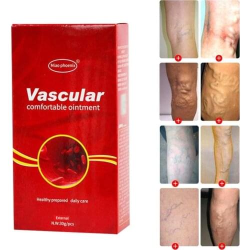 Varicose Veins Treatment Cream Ointment Vasculitis Phlebitis Spider Veins Pain Varicosity Angiitis Remedy Removal Herbal Cream