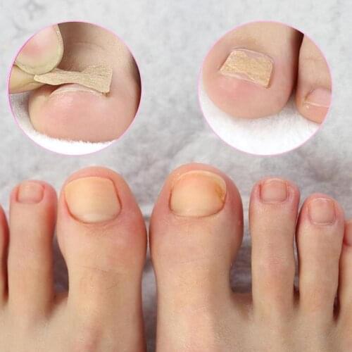 1.3 * 1.8cm 10 Pcs/Set Ingrown Toenail Corrector Stickers Corrector Treatment Paronychia Recover Tools Pedicure Fingernail O2O2