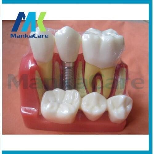 1 PC Dental Material Dental 4 Times Teeth Implant Model Disease Teeth Model With Restoration Bridge Crown For Medical Study