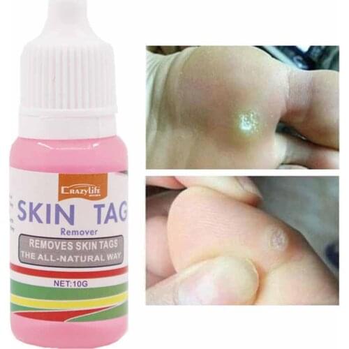 Wart Remover Painless Calluses Skin Tag Remover Device for Small Medium Skin Tags Remove Wart Liquid 10ml