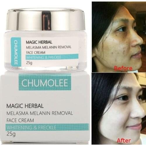 CHUMOLEE Strong Whitening Cream Freckle Cream Remove Melasma Acne Dark Pigment Spots Melanin Pimple Cream Face Cream Skin Care