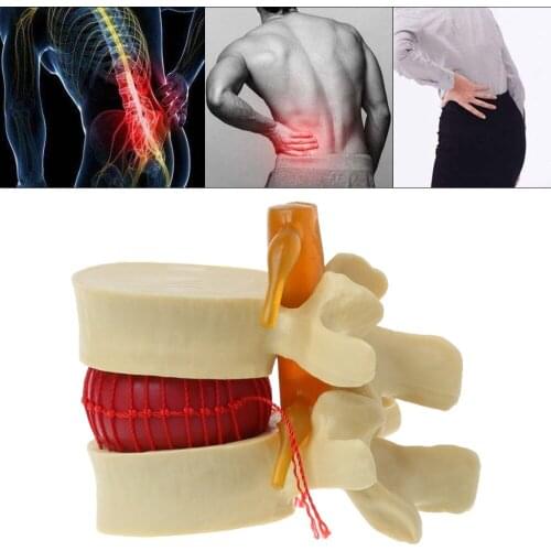 Anatomical Spine Lumbar Disc Herniation Anatomy Medical Model Teaching Tool School Supplies Medical Instrume C26