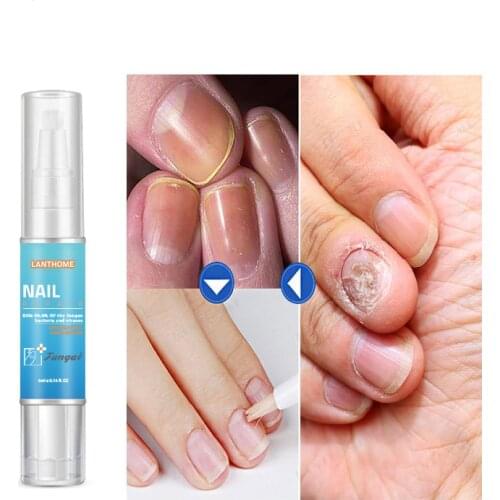 Nail Treatment Liquid Pen Anti Onychomycosis Paronychia Fungal Nail Infection Chinese Herbal Toe Fungus Healthy Care