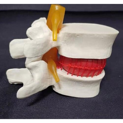 Human Anatomical Spine Lumbar Disc Herniation Medical Props Model Anatomy Medical Teaching Tool