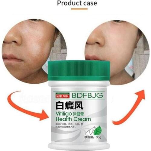 30ml Sumifun Chinese Vitiligo Ointment For Daytime Symptoms On Face Neck Back Of Hands Liniment Treatment Cream