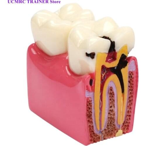 Dental Anatomy EducationTeeth Model M4021/6 Times Caries Comparation Study Model Dentist Studying/dental caries plastic model