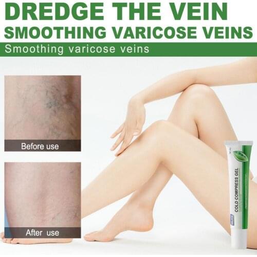 Varicose Veins Gel And Treatment Pen Effective Relieve Veins Treatment Herbal Natural Cream Varicose Phlebitis Angiitis G9A4