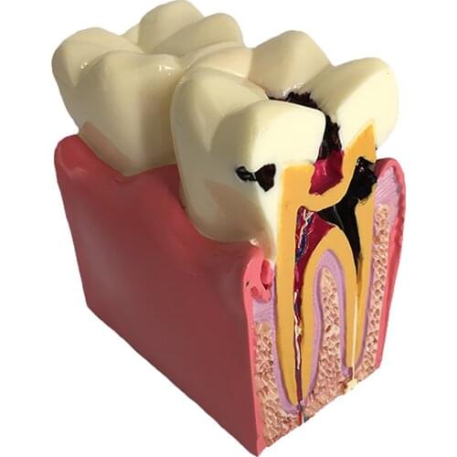 Comparison Model Teeth Disease Health Model Human Anatomical Model for School Teaching Tool Learning Display Lab Supplies