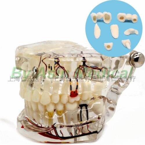 New arrival dental teeth model Transparent pathological implant nerve model Teaching demonstration model