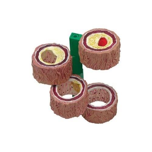 Atherosclerosis Thrombosis model Vascular disease Demonstration Heart Vascular pathology model