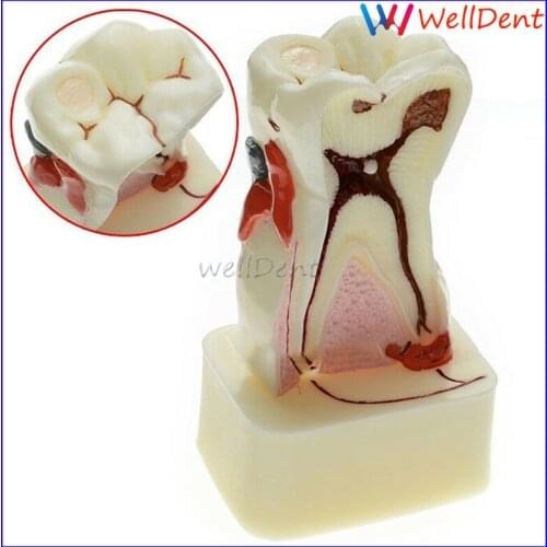 Dental Study Teaching Tooth Model Teeth Comprehensive Disease Dental Lab Dentist Dental Materials