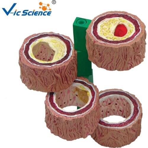 Medical Model Human Arteriosclerosis Pathological Model