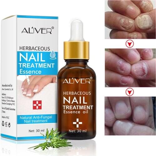 Nail Treatment Onychomycosis Paronychia Anti Fungal Nail Infection Good Result Chinese Herbal Toe Nail Fungus Treatment 30ml