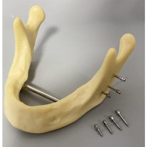 5Pis/Lot Orthodontic Screws Micro Implants Mini Screw Dental Self-Drilling Driver Spring Anchorage Implant Driver Screwdriver