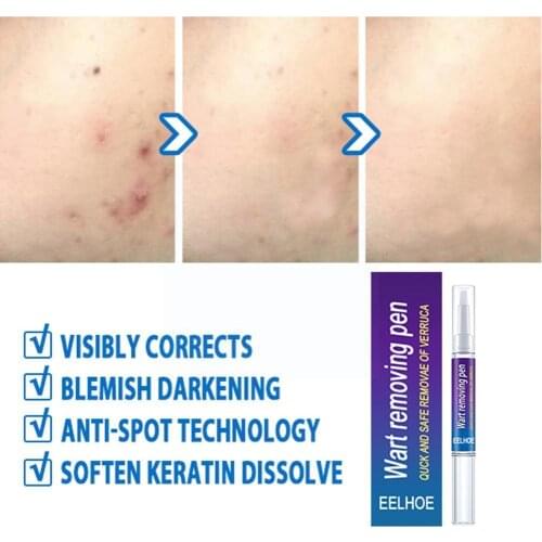 Removal Genital Wart Treatment Papillomas Skin Tags Verruca Against Anti Remedy Effective Moles Remover Rapidly Removing