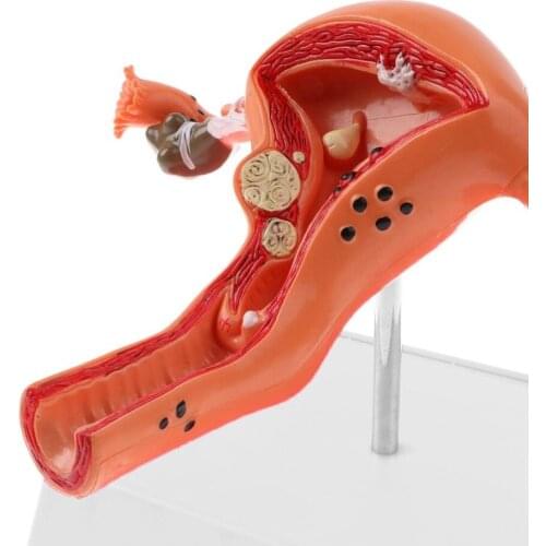 Human Female Uterus Pathology Model Body Woman Pathological Uterus Ovary Anatomical Model Anatomy Cross Section