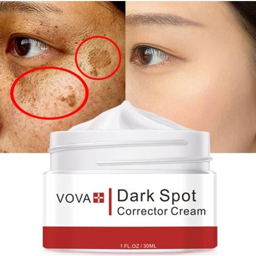 Effective Whitening Freckle Cream Remove Melasma Acne Spot Pigment Melanin Dark Spots Pigmentation Moisturizing Gel Skin Care