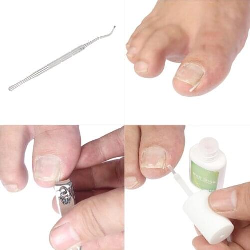 10pcs/box Ingrown Nail Pad Nail Filling Nail Groove Pad Ingrown Toenail Corrector Ingrown Nail Artifact