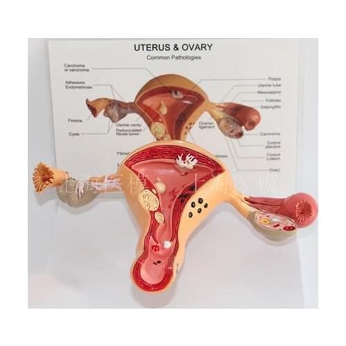 UTERUS &OVARY common pathologies Uterine Disease Ovarian disease Ovarian anatomical model Obstetrics and Gynecology