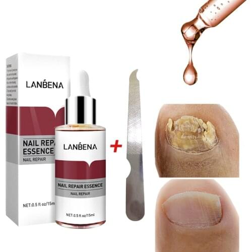 Fungal Nail Treatment Essence Foot Nail Fungus Removal Gel Anti Infection Paronychia Onychomycosis Toe Nail Care Repair Serum