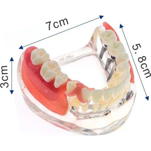 Dental Mandible Implant Overdenture Teeth Model with vessels Demo #6006