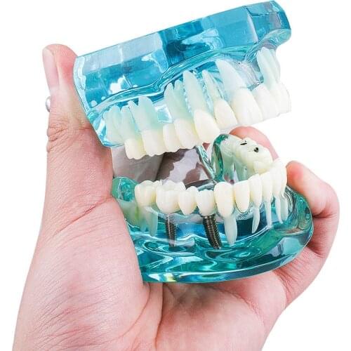 1 PC Dental Study Tooth Model Adult Pathological Teaching Teeth Model