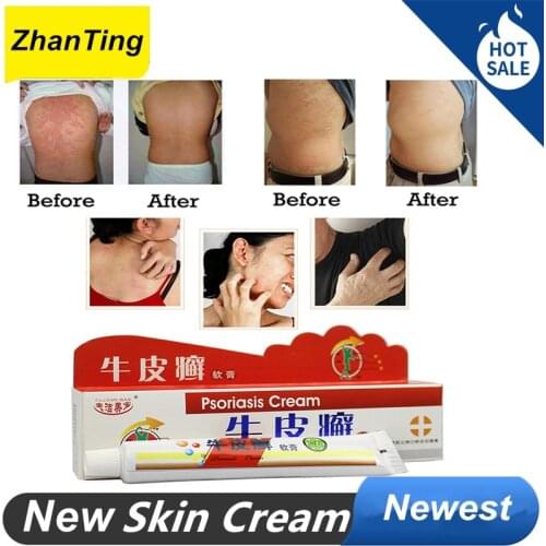 ZhanTing 3 Pcs Psoriasis Cream Ointment Body Massage Patches Various Skin Diseases Antibacterial Cream