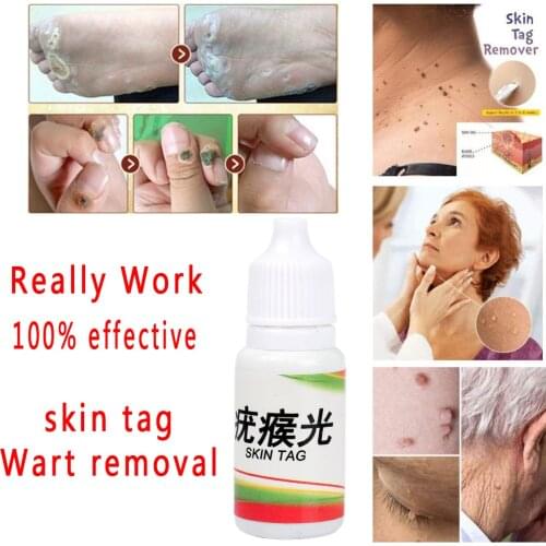 100% Really Work** Body Warts Corn Mole Genital Wart Treatment Cream Skin Tag Remover Foot Corn Removal Plantar Warts