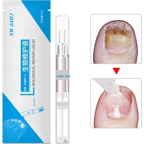 3m Toe Finger Nails Pen Onychomycosis Paronychia Infection Treatment Liquid Toe Finger Nails Pen Treatment Liquid
