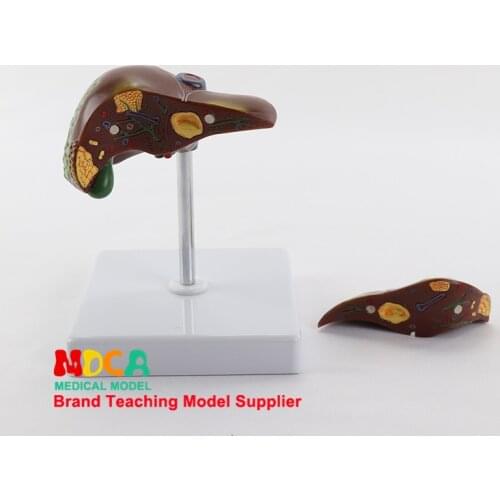 Model Medicine Teaching MGZ003 in Digestive Medicine of Pathological Liver Stone Model