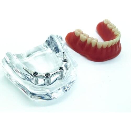 Teeth mandibular implant model Repair teeth implant model Denture Dental Teaching Model