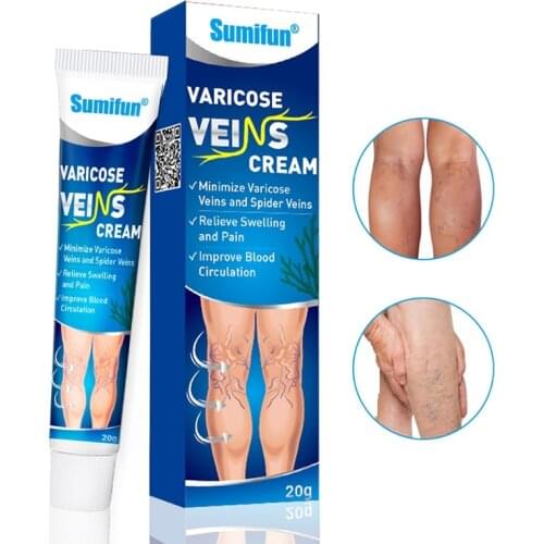 Varicose Veins Treatment Cream Vasculitis Phlebitis Spider Cream Varicosity Angiitis Removal Medical Plaster