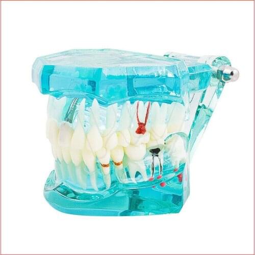 Dental Implant Study Analysis Demonstration Teeth Disease Model Restoration