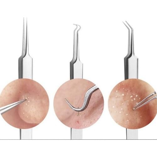 200 pcs Stainless steel curved blackhead acne clip pimple comedone remover face cleaner 11cm/4.33in