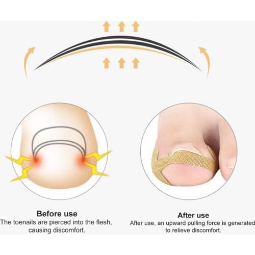 1 Set Toe Corrector Stickers Breathable Nail Care Manicure Ingrown Toe Nail Correction Patch Foot Care
