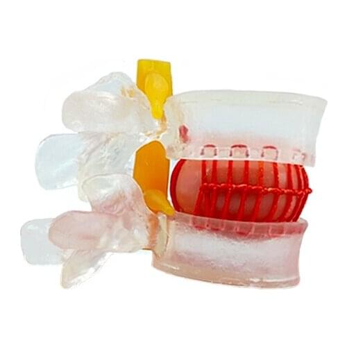 Intervertebral disc spine model medical human body lumbar herniated spine pathological demonstration joint model