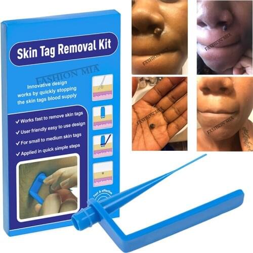 Micro skin tags remover kit remove warts body skin care tools health safety face Skin Tag Removal patch Acne Tag Remover band