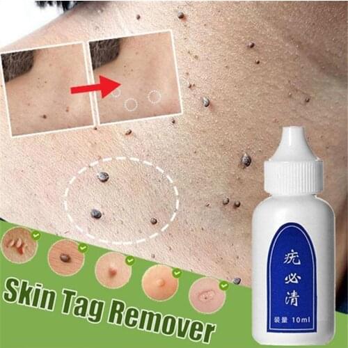 Genital Wart Treatment Papillomas Removal of Warts Liquid From Skin Tags Removing Against Moles Remover Wart Removal liuld