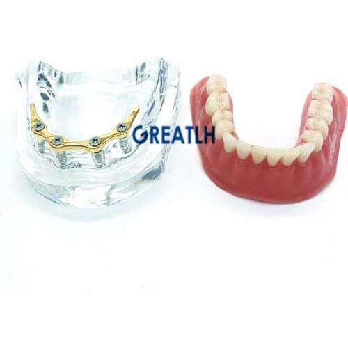 Repair teeth model with implant with Silver Bar Denture Teeth mandibular model Dental Teaching Model