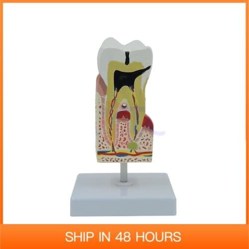 Enlarged Human Teeth Care Model Tooth Decay Dental Caries Medical Student Supplies Teaching Resources Anatomical