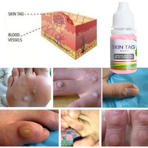10ml Skin Tag Remover Liquid Foot Corn Plantar Body Warts Treatment Ointment MOLF