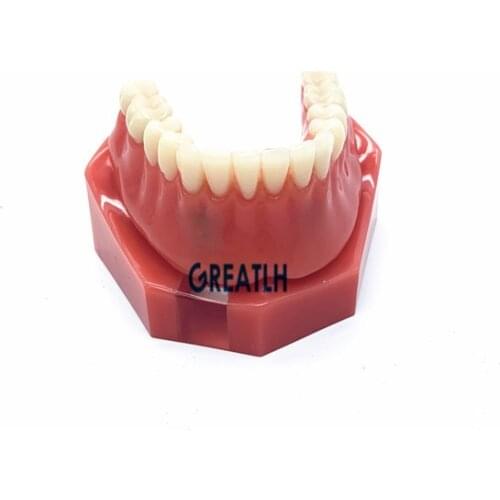 Dental Overdenture model with 2 implants Teeth Model for Dental school dentist learning Dental Teaching Model