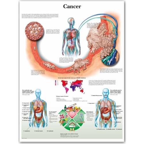 WANGART Cancer Chart Art Poster Print Body Map Canvas Wall Pictures for Medical Education Home Decor
